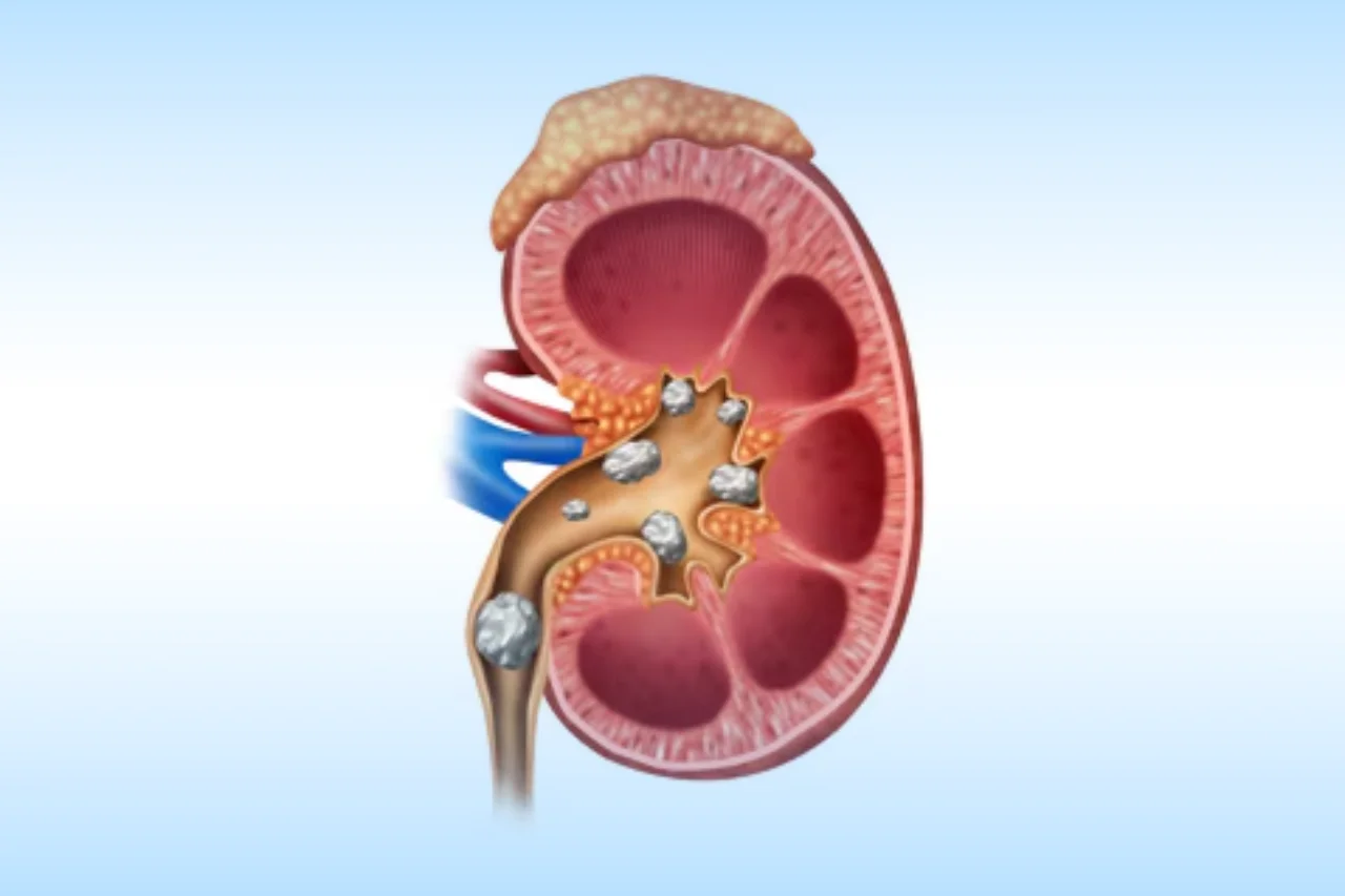 urinary Tract calculi - dr-aman-chandra hyderabad